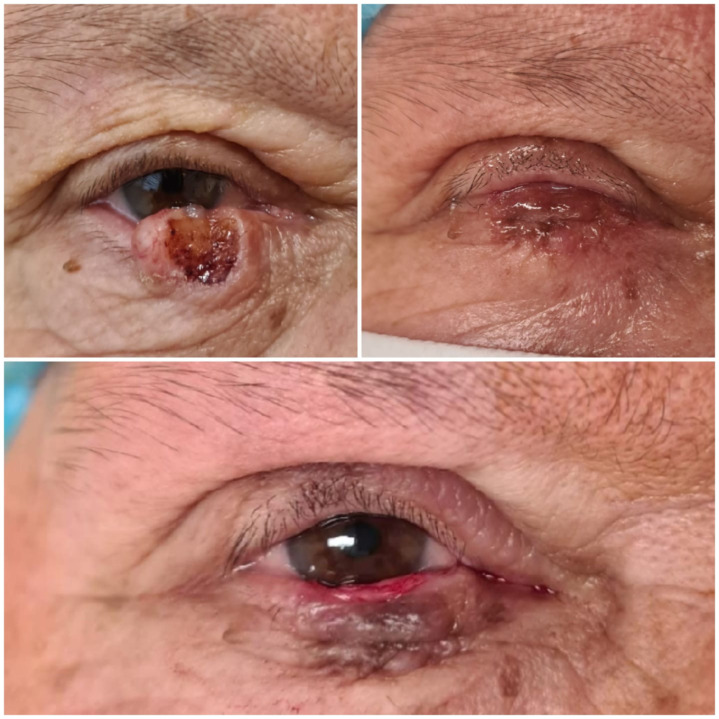 Interventie la oftalmologie-carcinom bazocelular operat in doi timpi